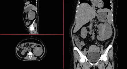 Renal subcapsular abscess is a suppurative process localized to a single area of the kidney.  localized to a space between the renal capsule and the renal parenchyma