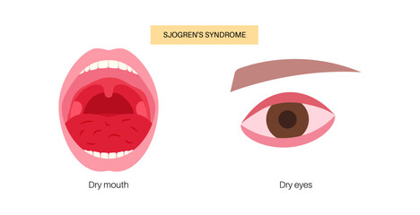 Sjogrens syndrome disease