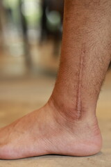 Fototapeta premium Close-up of a surgical scar on human skin, showing healing tissue, injury recovery, pain, vulnerability, healthcare, medicine, and resilience. 