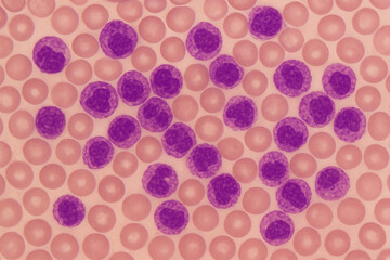 Bone marrow aspirate close-up with leukemia, excess white cells crowding red cells, realistic hematology slide rendering.