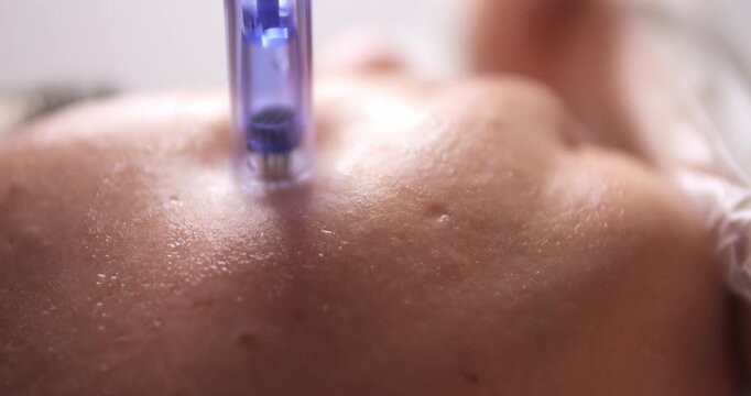 Cosmetic procedure microneedling. Facial skin care. A woman undergoes a procedure for restoring and regenerating facial skin. A cosmetologist works in a cosmetic office.