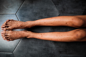 Itchy skin rash and red spots all over a girl's legs and feet. Skin problem, allergy or dermatology concept.