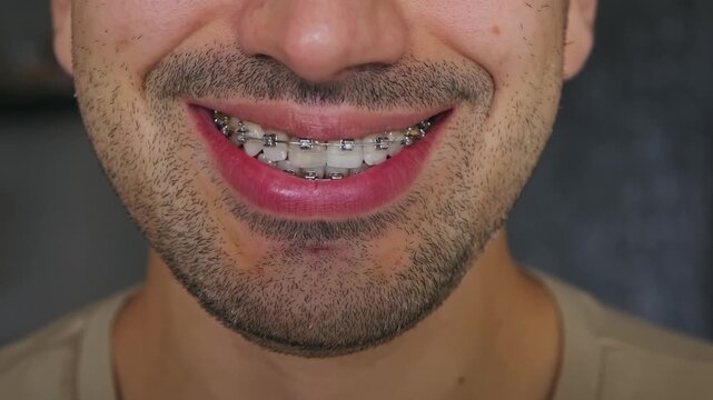 Close-up of a man's smile with braces. Metal braces. No embarrassment. 