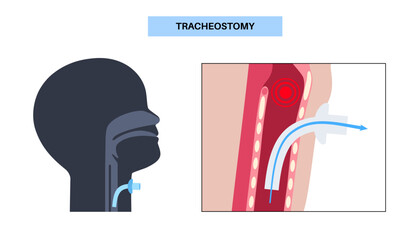 Tracheostomy medical poster