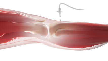 Intraosseous infusion in shin bone, illustration