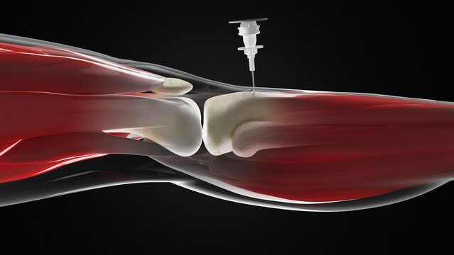 Intraosseous infusion in shin bone, illustration