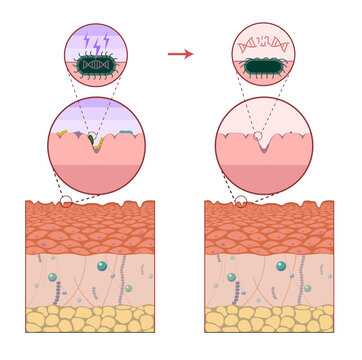 Light and UV therapy for acne, illustration