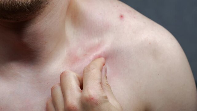 Cartilage on the body in the collarbone area.
Injured collarbone on a man's body.
Bone injury.
Body parts and human anatomy.
Human body structure and skeleton