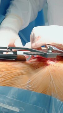 Surgeon expands patient chest with dilator closeup. Doctor prepares wound for coronary artery bypass surgery in hospital. Medical procedures
