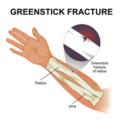 Greenstick Fracture Bone Flashcard Illustration