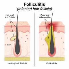 Folliculitis (infected hair follicle) skin flashcard illustration