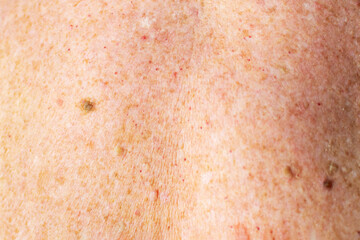 Senior woman with moles, papillomas and pigmentation spots on her back, skin cancer, malignant tumor prevention, health care, oncology risk, dermatology disease.