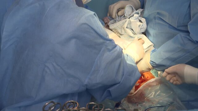 A close-up of a C-section delivery shows a medical team in sterile gowns and gloves carefully assisting the birth of a newborn baby.
