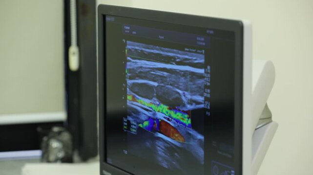 This close-up shot shows a color Doppler ultrasound screen displaying blood flow within a vessel. The colorful display highlights the direction and velocity of blood circulation.