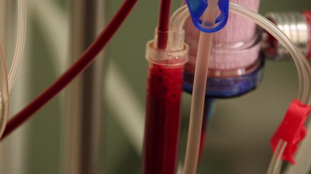  A close-up view of a hemodialysis machine during setup. A person in gloves is carefully connecting tubes to the equipment, which features red and clear tubing, a filter, and various connectors.