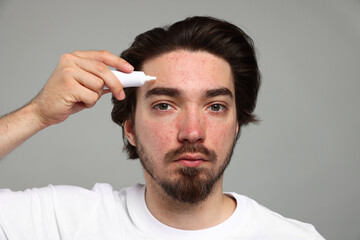 Young man with acne problem applying cream onto his face on light grey background