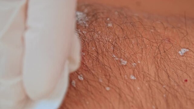 Dermatology Nurse Practitioner Cosmetician Squeezing Pimple Furuncle from Patient Skin