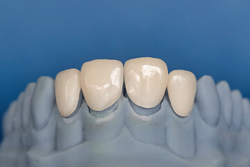 Plaster model of upper jaw with four ceramic veneers placed in front. Concept of cosmetic dentistry, smile design, and dental prosthetics for aesthetic treatment. © Tatiana