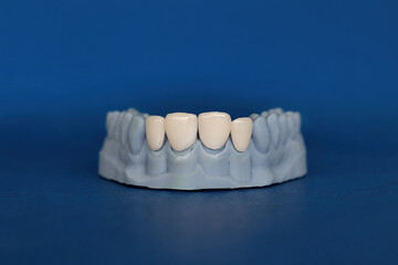 Plaster model of upper jaw with four ceramic veneers placed in front. Concept of cosmetic dentistry, smile design, and dental prosthetics for aesthetic treatment. © Tatiana