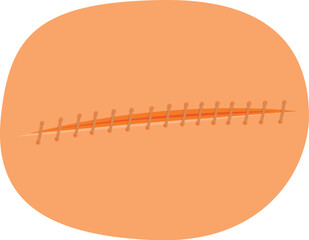 Skin scar with surgical sutures closing wound after medical procedure