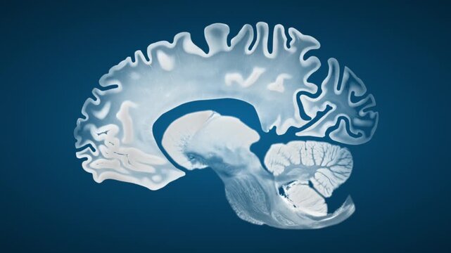 Sagittal brain visualization highlighting cortical thinning and ventricular enlargement in Alzheimer disease, presented on a blue background to emphasize structural neurodegeneration.