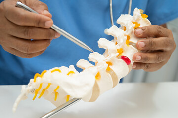 Asian doctor holding spinal nerve and bone model, Lumbar spine displaced herniated disc fragment...