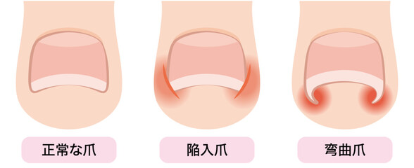 巻き爪・陥入爪・弯曲爪