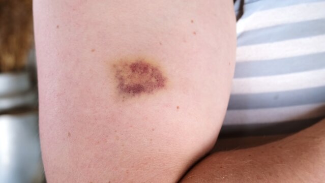 The bruise on skin close-up view. Various shades of healing process. Dark purple and yellow bruising colors on white skin. The violence concept. The consequences of injury. High quality 4k footage