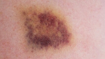 Fototapeta premium The bruise on skin close-up view. Various shades of healing process. Dark purple and yellow bruising colors on white skin. The violence concept. The consequences of injury. High quality 4k footage