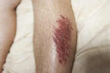 Close up photo of a fresh abrasion wound on a human leg. Red scratched skin injury on hairy male limb, useful for medical, healthcare, accident, first aid, treatment, and trauma concepts. High quality