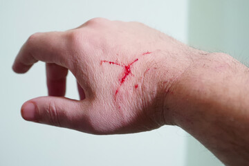 Hand with fresh cuts, scratches and blood from accident or pet animal attack