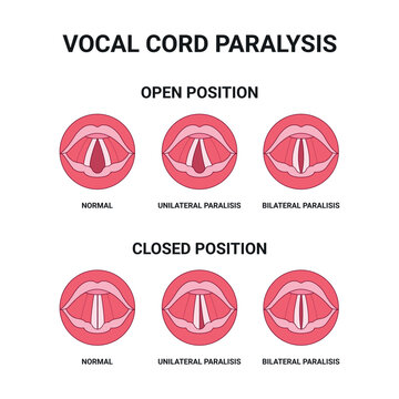 Vocal cord (vocal fold) paralysis: comparison of normal, unilateral, and bilateral paralysis with positions in breathing and phonation. Voice, breathing, and swallowing disorders. Medical vector.