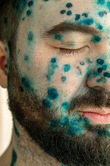 Adult man half face with strong aggressive varicella or chicken pox. Pink spots, papules, vesicles. Treatment of chickenpox with brilliant green Zelenka.