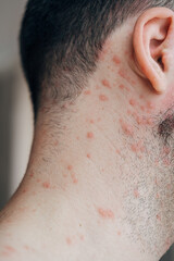 Adult man neck and body with strong aggressive varicella or chicken pox. Pink spots, papules, vesicles.