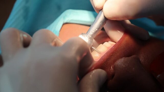 Close-up of tooth surface preparation for veneer placement with rotary dental drill and water cooling. Concept of cosmetic dentistry, precision work, and oral care.