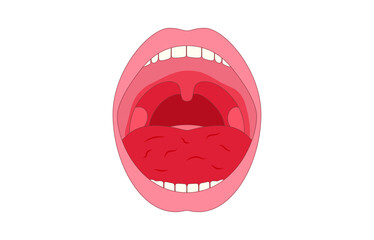 Xerostomia or dry mouth