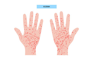 Eczema medical poster