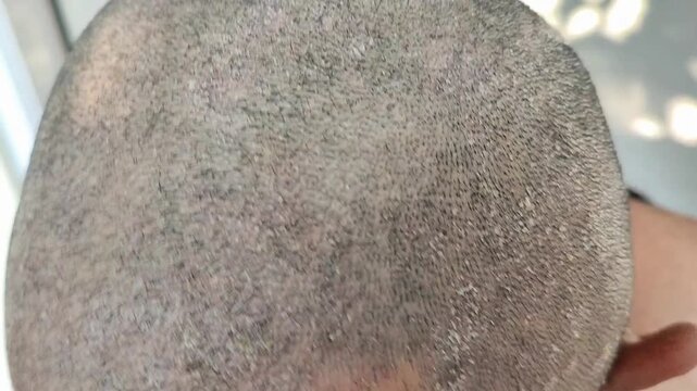 Close-up of a bald man's head with seborrheic dermatitis and dandruff. Concept of scalp health problems with seborrhea, seborrheic dermatitis or dandruff