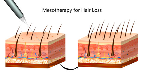 Medical Illustration of Mesotherapy Injection for Hair Loss Treatment. Dermatology Procedure Mesotherapy for Hair Follicle Stimulation