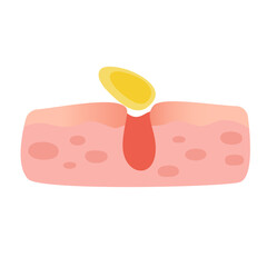 Acne facial type concept. vector illustration