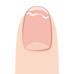 二枚爪・爪甲層状分裂症