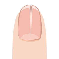 亀裂の入った爪・爪甲縦裂症