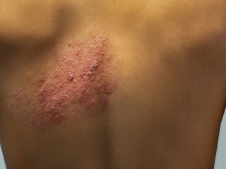 Skin of a man with Herpes zoster or Shingles