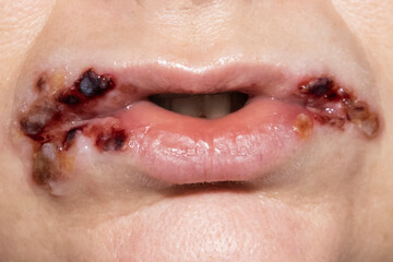 Infection on lips. Crack in the corner of the mouth, sores around the mouth, sore on the lips with dry blood on the woman face.