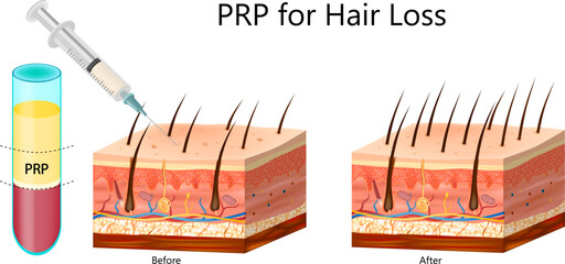 PRP Therapy for Hair Loss Before and After Illustration. Platelet Rich Plasma Injection for Hair Regrowth Diagram. Treatment for Scalp and Hair Follicles