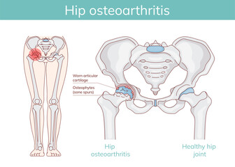 Hip Osteoarthritis vs. Normal Joint – Medical Illustration of Degenerative Changes