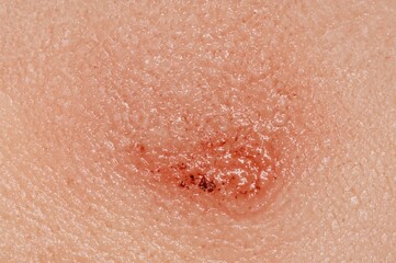 Fototapeta premium Close-up of skin affected by dermatitis and eczema, showing detailed texture of allergic rash and atopic symptoms, fungal infection focus, dermatology treatment concept