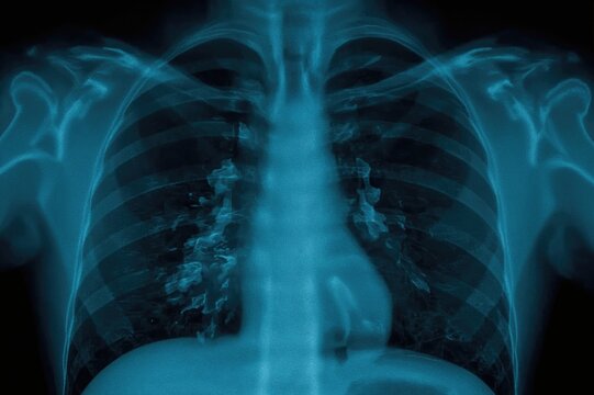 Child's Chest X-ray Reveals Patchy Infiltration in Right Middle Lung Indicating Pulmonary Tuberculosis