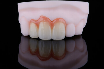 High-quality three dental crowns made of zirconium for fixation to the frontal teeth of upper jaw.