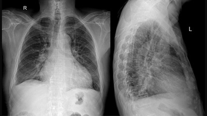 X-ray of chest showing thoracic anatomy – frontal and lateral views